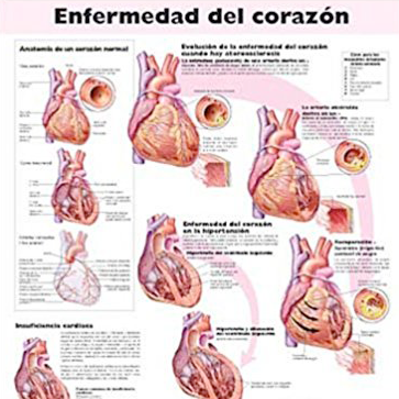 Poster laminado  medidas 66 cm x 51 cm enfermedad corazon